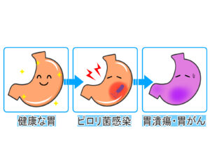 ピロリ菌から胃癌を発症する説明画像